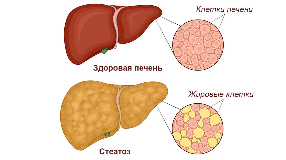 Заболевания печени -симптомы и лечение